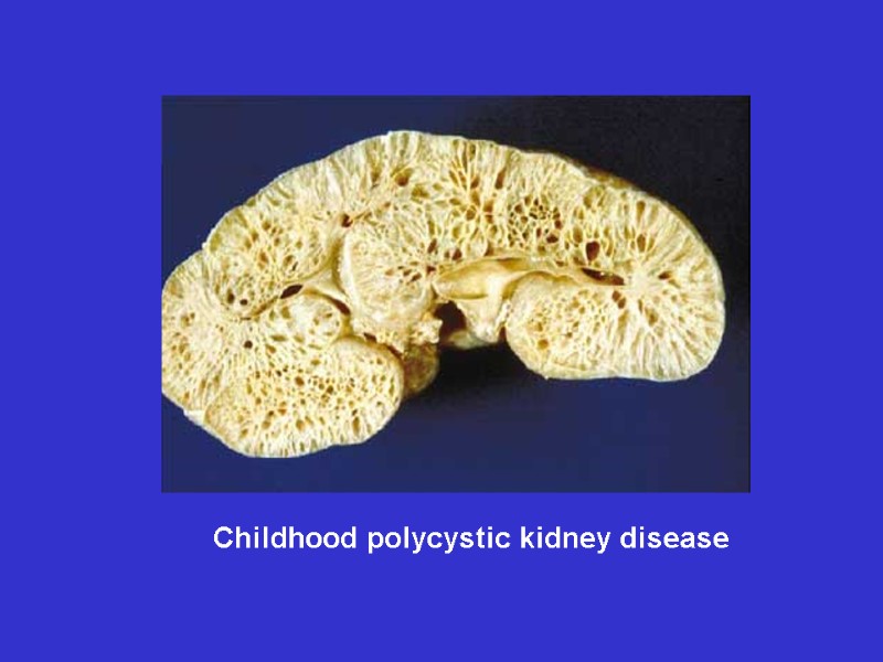 Childhood polycystic kidney disease